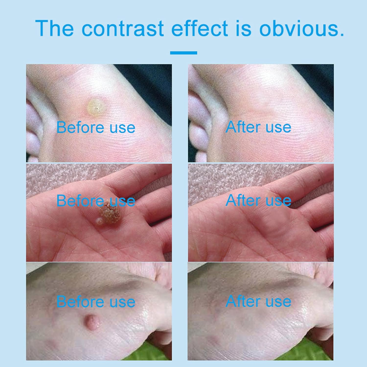 Skin-Tag-Remover, Wart Remover, Mole & Wart-Remover Liquid, Fast-Acting Skin-Tag-Remover for Tag Removal & Verruca-Treatment image number 4