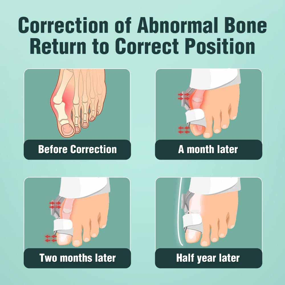 Adjustable Knob Bunion Splint Bunion Corrector for Women Hallux Valgus Brace Splint Pads Bunion Big Toe Separators Straightener for Women & Men(1-Pcs) image number 2