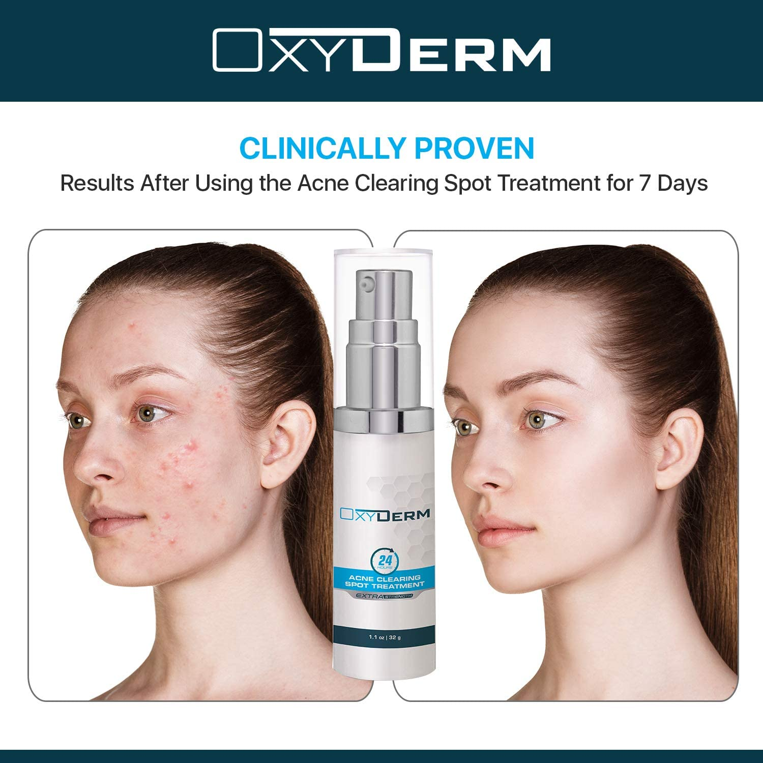 Acne Spot Treatment- Overnight Pimple Treatment for All Skin Types without over Drying Your Skin. Removal for Inflamed Blackheads, Whiteheads, Cystic Acne. Results within Hours for Adults & Teens. image number 4