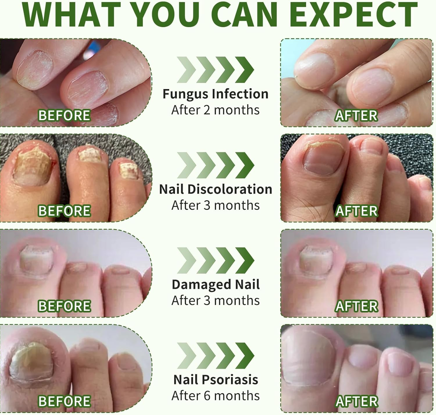 Nail Fungus Laser Treatment Device, Toenail Finger Nail Fungus Treatment with 470Nm Blue Light 660Nm Red Light and 905Nm Infrared Light, Natural Nail Fungus Cleaning Solution for Home Use image number 4