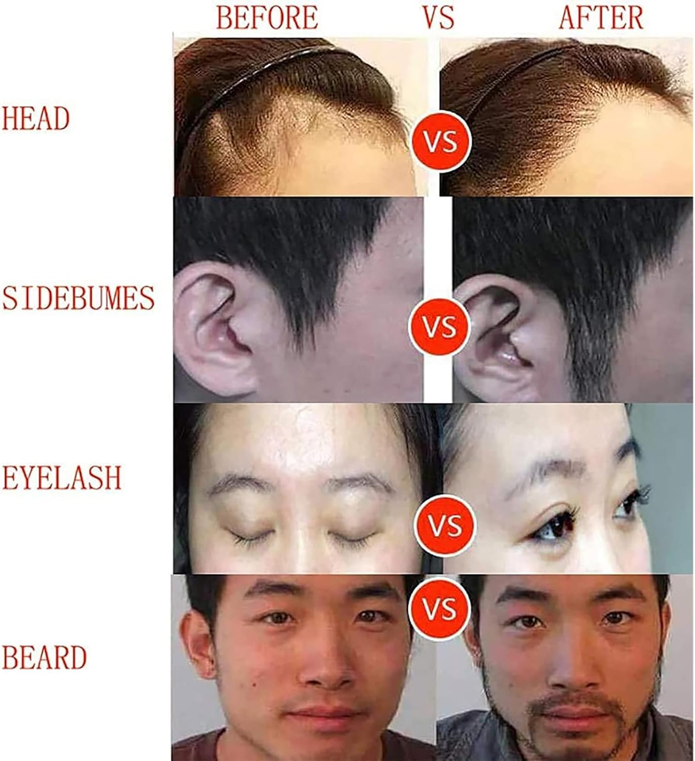 Hair Follicle Extractor, Hair Transplant Treatment Growth System with 0.8/0.9/1Mm Hair Transplant Size, 0-20000Rpm Stepless Speed Regulation, Safe without Scars, for Ease Helps Hair Loss image number 3