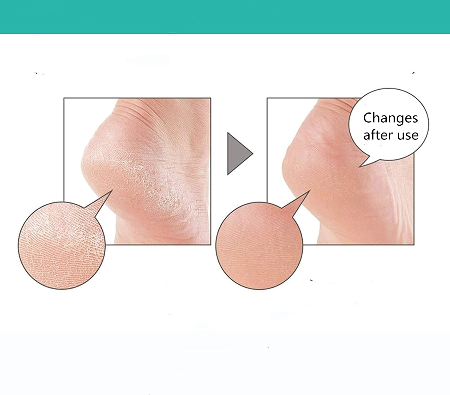 8 Pieces Soft and High Elastic Foot Pads - Plantar Fasciitis Pad, Heel Cup, Silicone Cover, Suitable for Cracking, Tendinitis, and Pain Relief image number 5