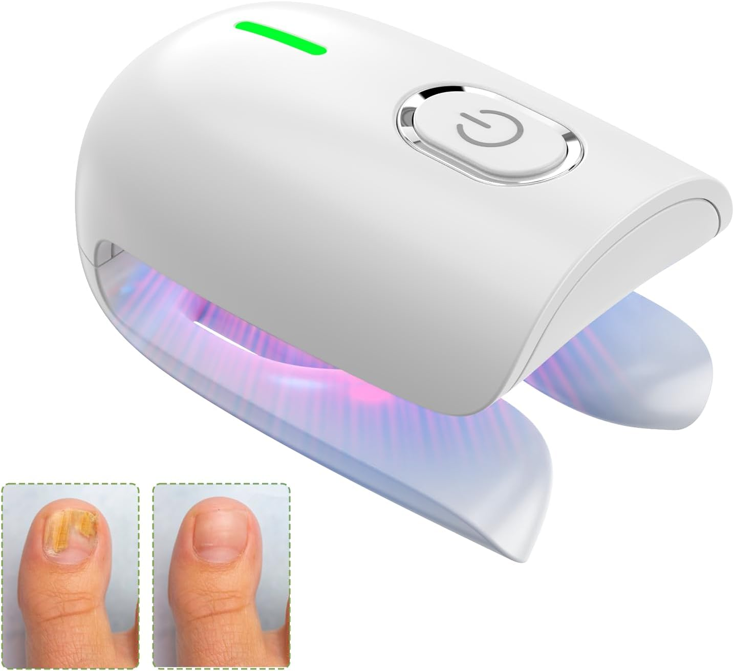 Nail Fungus Laser Treatment Device, Toenail Finger Nail Fungus Treatment with 470Nm Blue Light 660Nm Red Light and 905Nm Infrared Light, Natural Nail Fungus Cleaning Solution for Home Use image number 3
