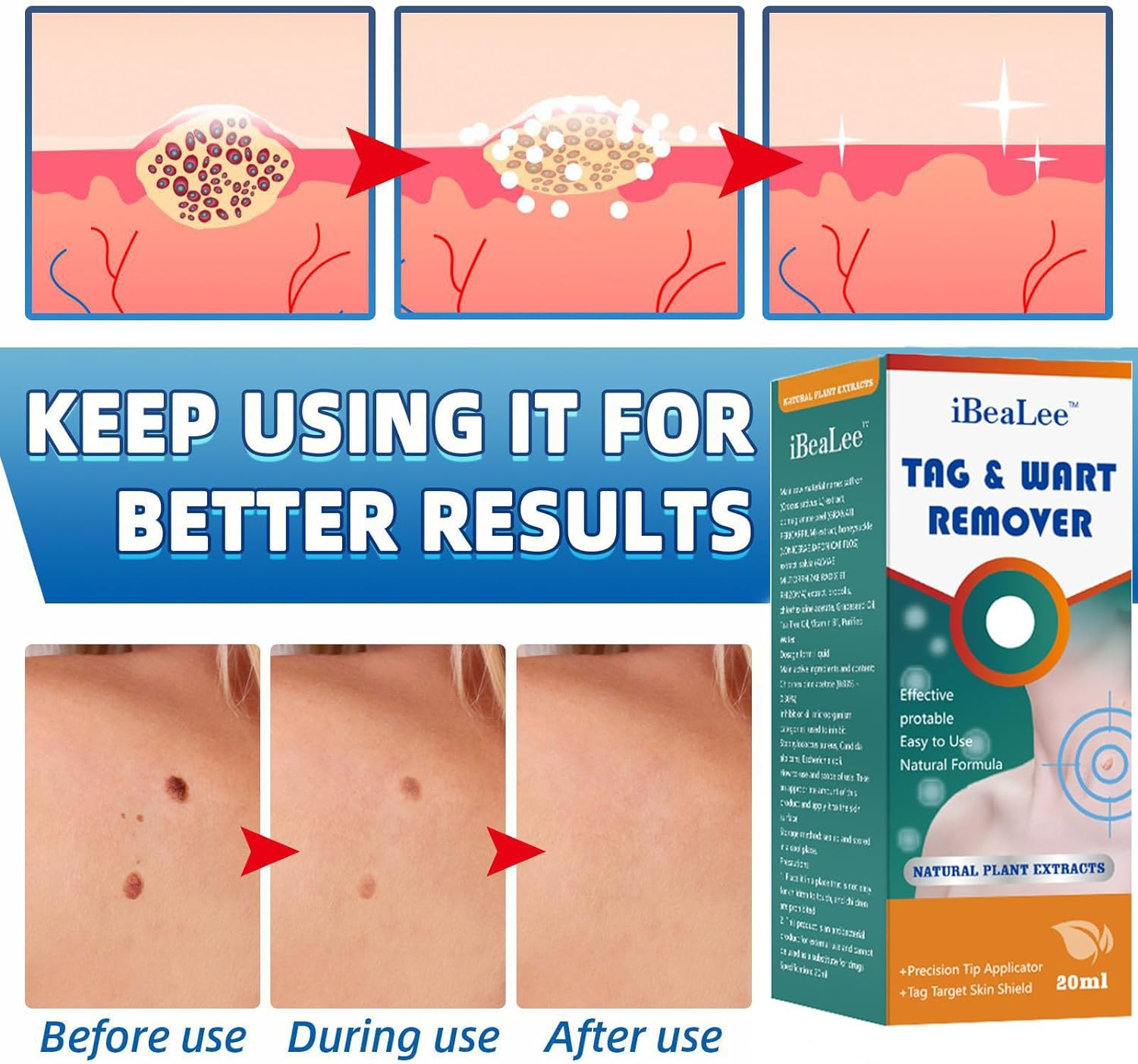 Skin Tag Remover,Wart Remover,Fliquid Wart Gel with Salicylic Acid - Fast Acting, Designed for Warts, Plantar Warts, Genital Warts, Common Warts, Flat Warts, Corns,Calluses image number 4