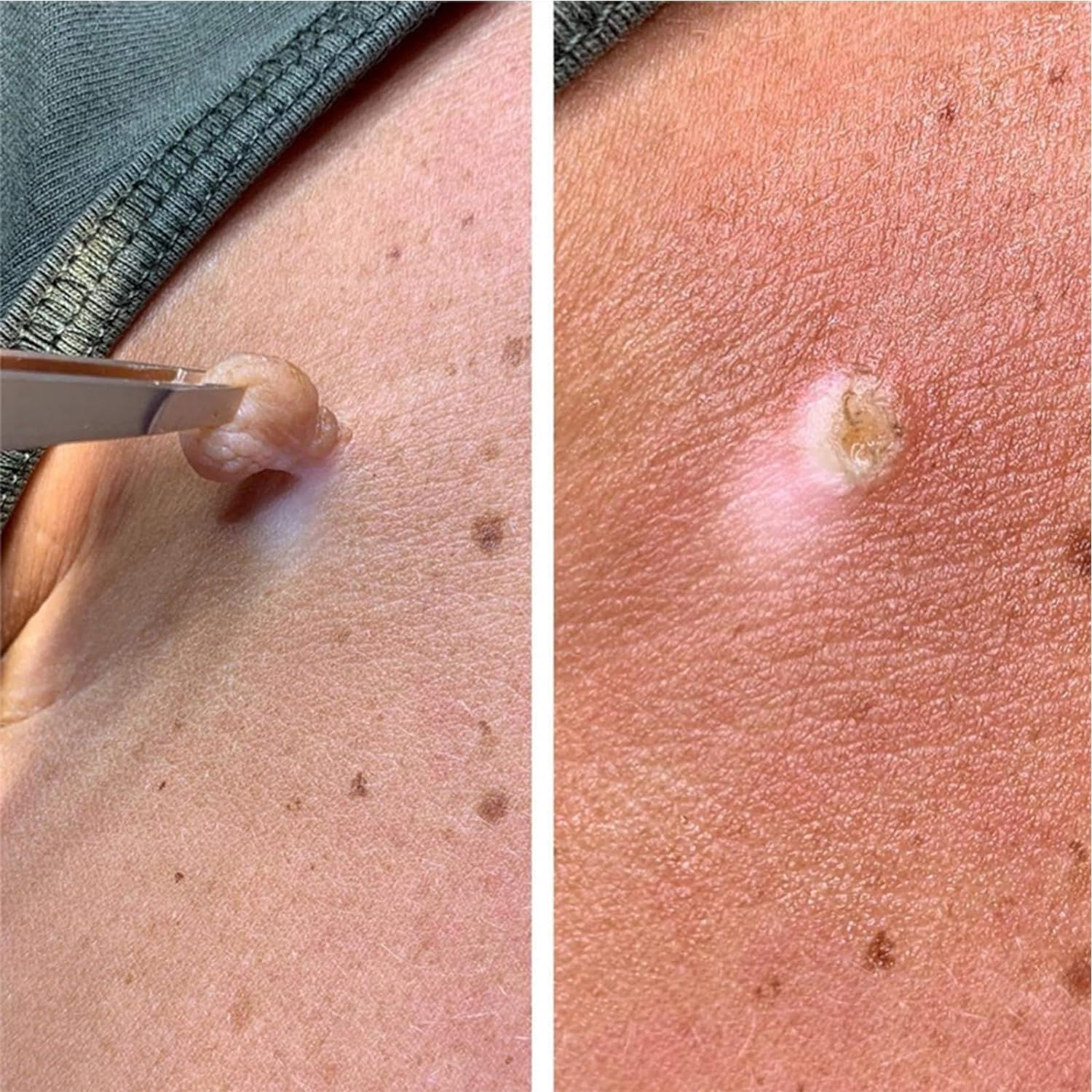 Skin Tag Remover,Wart Remover,Fliquid Wart Gel with Salicylic Acid - Fast Acting, Designed for Warts, Plantar Warts, Genital Warts, Common Warts, Flat Warts, Corns,Calluses